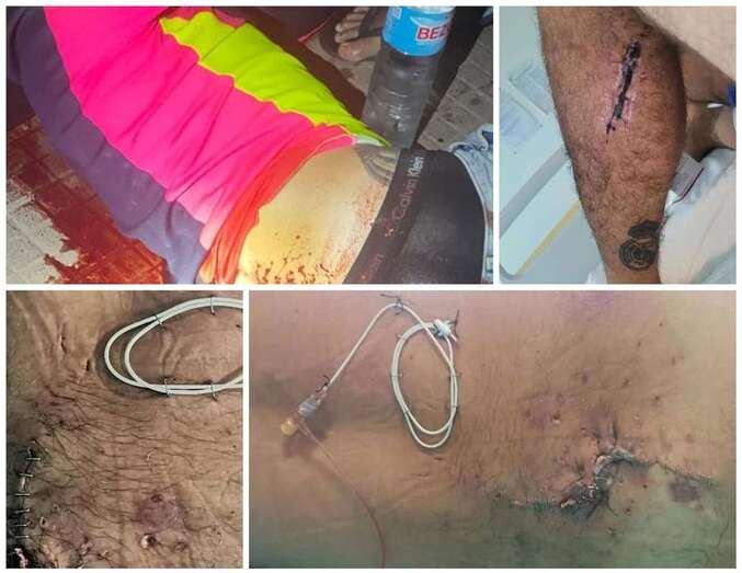 Imagen de las heridas que sufrió en la espalda/C7.